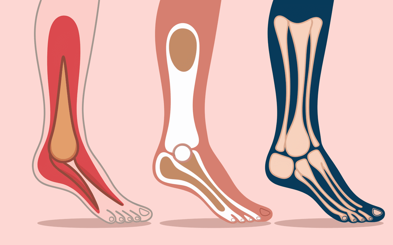 Illustration schématique des causes de douleur dessus du pied.